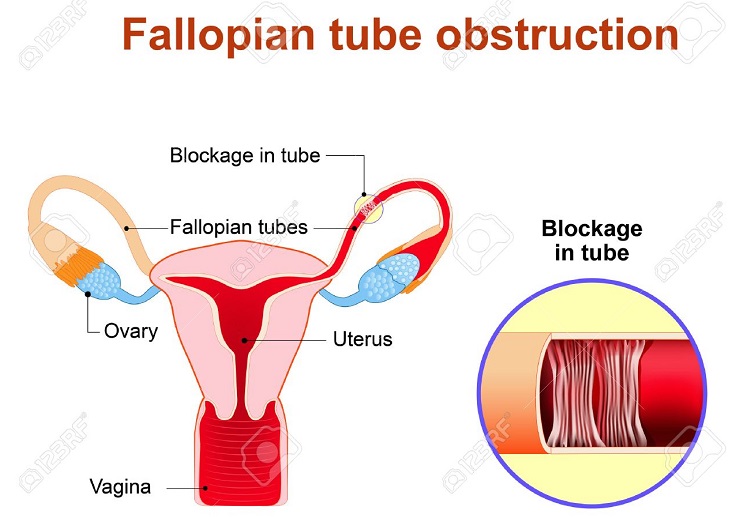 Fallopian Tube Anatomy Fallopian Tube Obstruction Or Blocked Fallopian Tubes. A Major