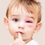 Insect Stings in child