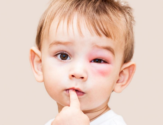 Insect Stings in child