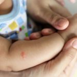 Mosquito bites in babies