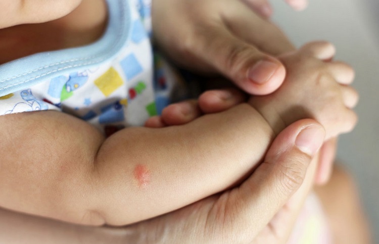 Mosquito bites in babies