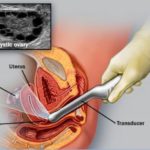 Understanding the Follicular Study