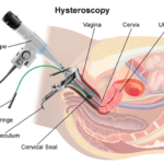 hysteroscopy