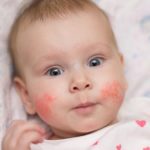 baby Sunburn cure